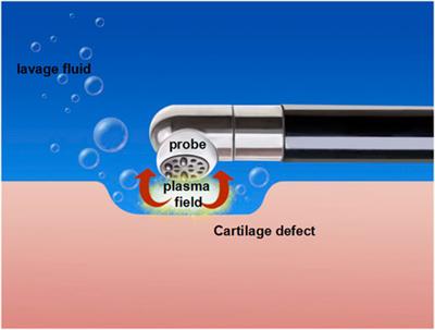 The Arthroscopic Application of Radiofrequency in Treatment of Articular Cartilage Lesions